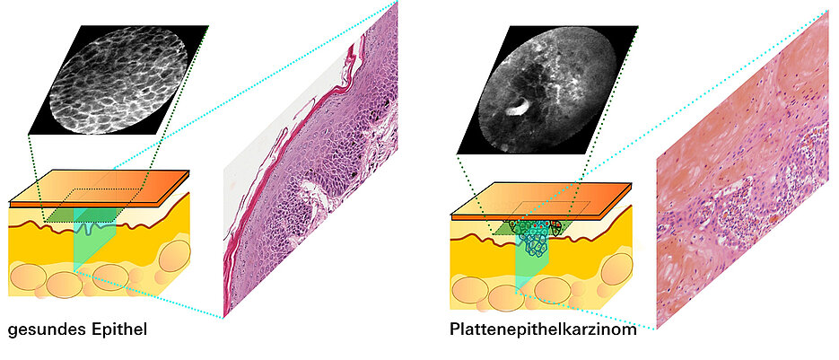 Mit neuer Technik zu besseren Ergebnissen: Während die histopathologischen Bilder von Christof Bertram von Schnittpräparaten stammen, werden die Bilder der konfokalen Laserendomikroskopie parallel zur Hautoberfläche aufgenommen.